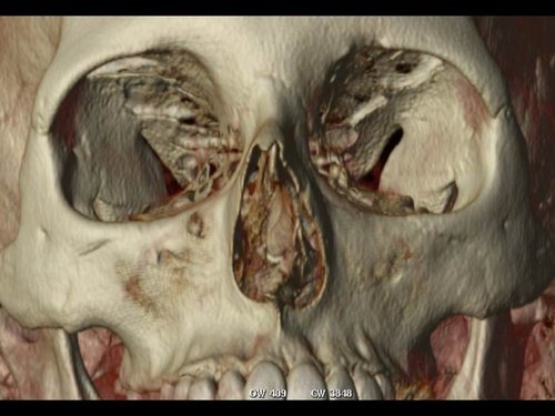 Dr+Derderian+3D+CT+Example+Deviated+Septum.jpg