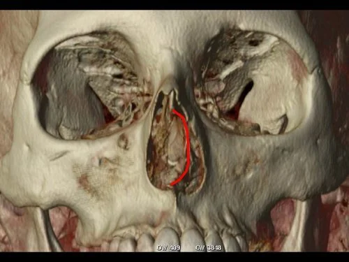 Dr+Derderian+3D+CT+Example+Deviated+Septum+Outlined.jpg
