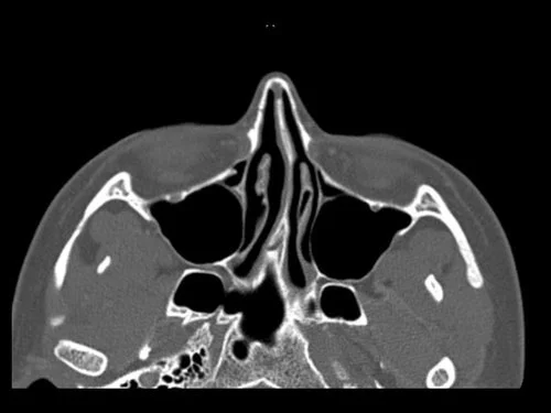 Dr+Derderian+Axial+Ct+Image+1+Deviated+Septum.jpg
