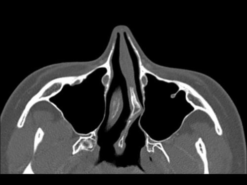 Dr+Derderian+Axial+Ct+Image+2+Deviated+Septum.jpg