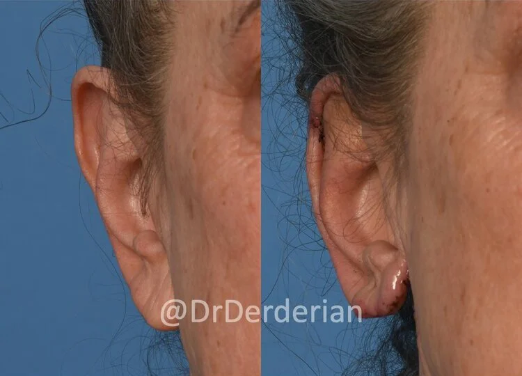 before and after ear reduction procedure, reduction otoplasty ear lobe reduction front view