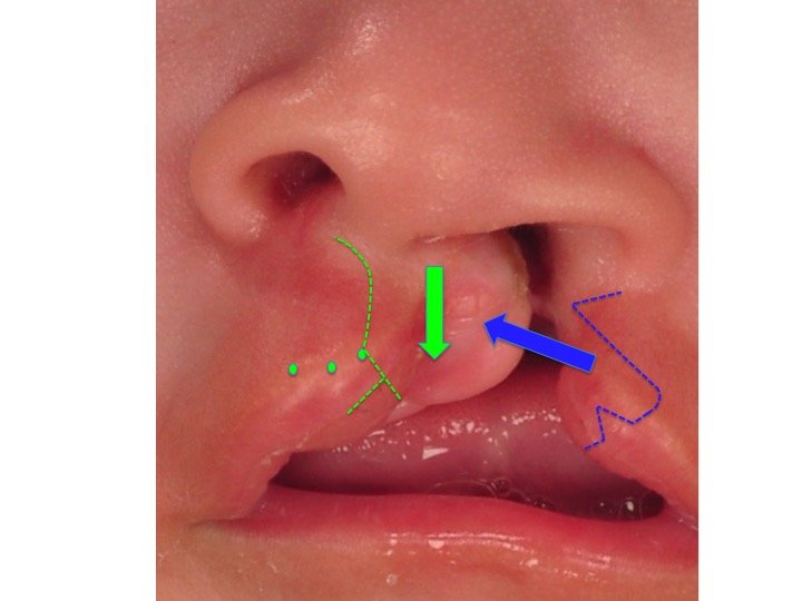 Unilateral+Cleft+Repair+Schematic.jpg