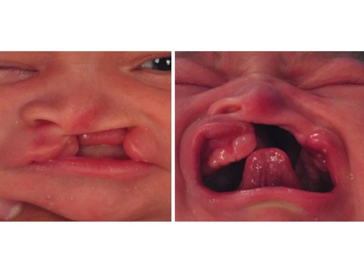 presenting+cleft+deformity+for+NAM.jpg