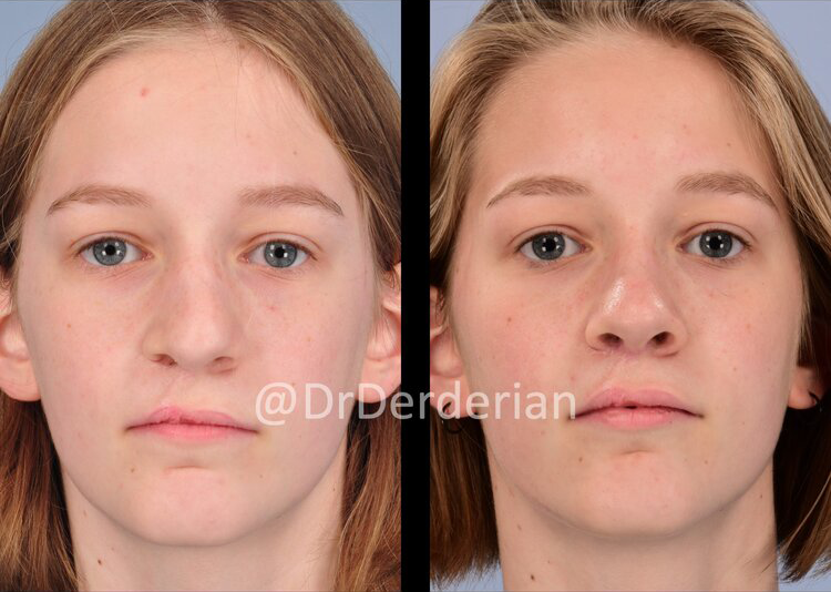 Cleft Rhinoplasty — Dr Derderian — Plastic and Reconstructive Surgery