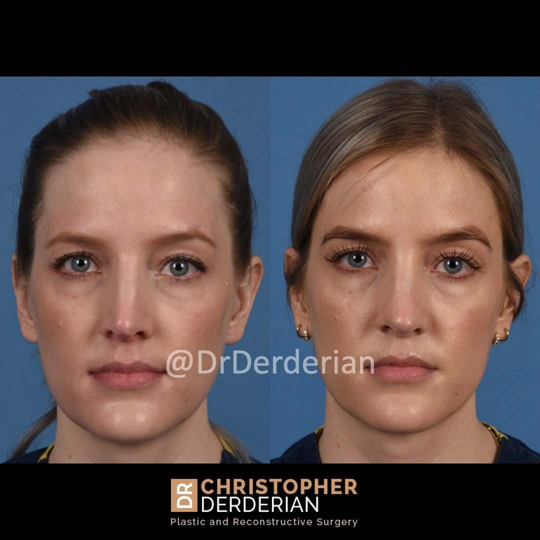 drderderian rhinoplasty before and after 2 AP.jpeg