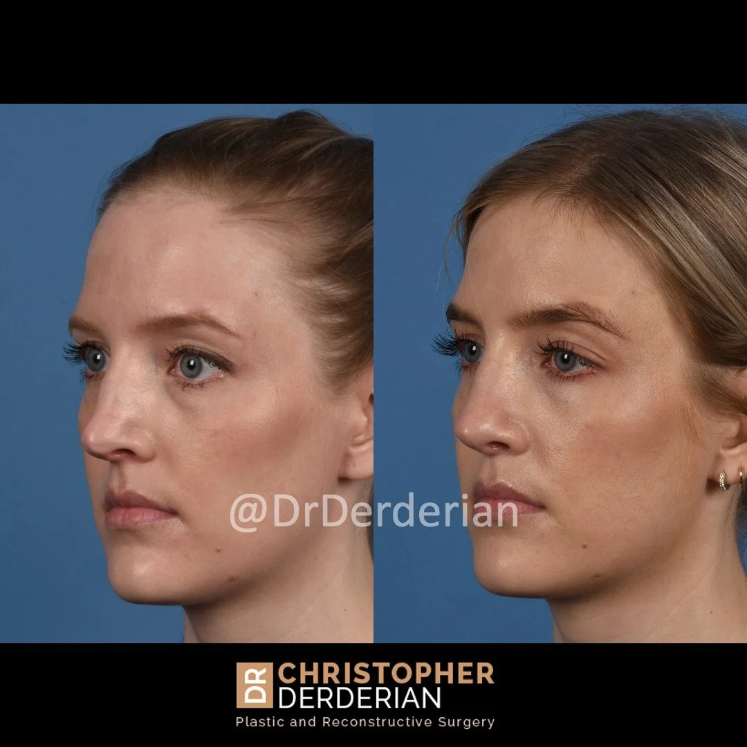 drderderian rhinoplasty before and after 2 left 3:4.jpeg