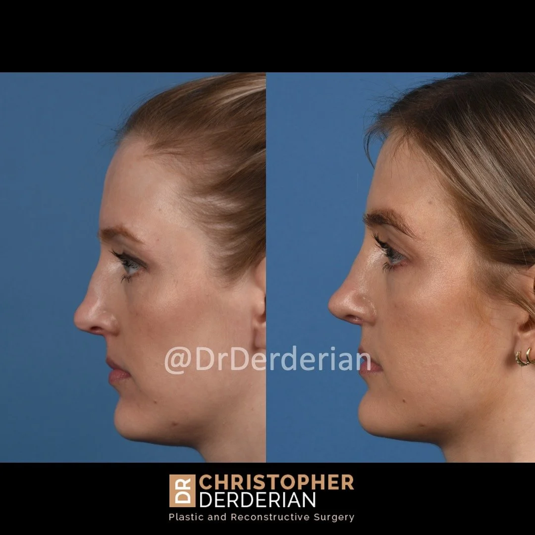 drderderian rhinoplasty before and after 2 left lateral.jpeg