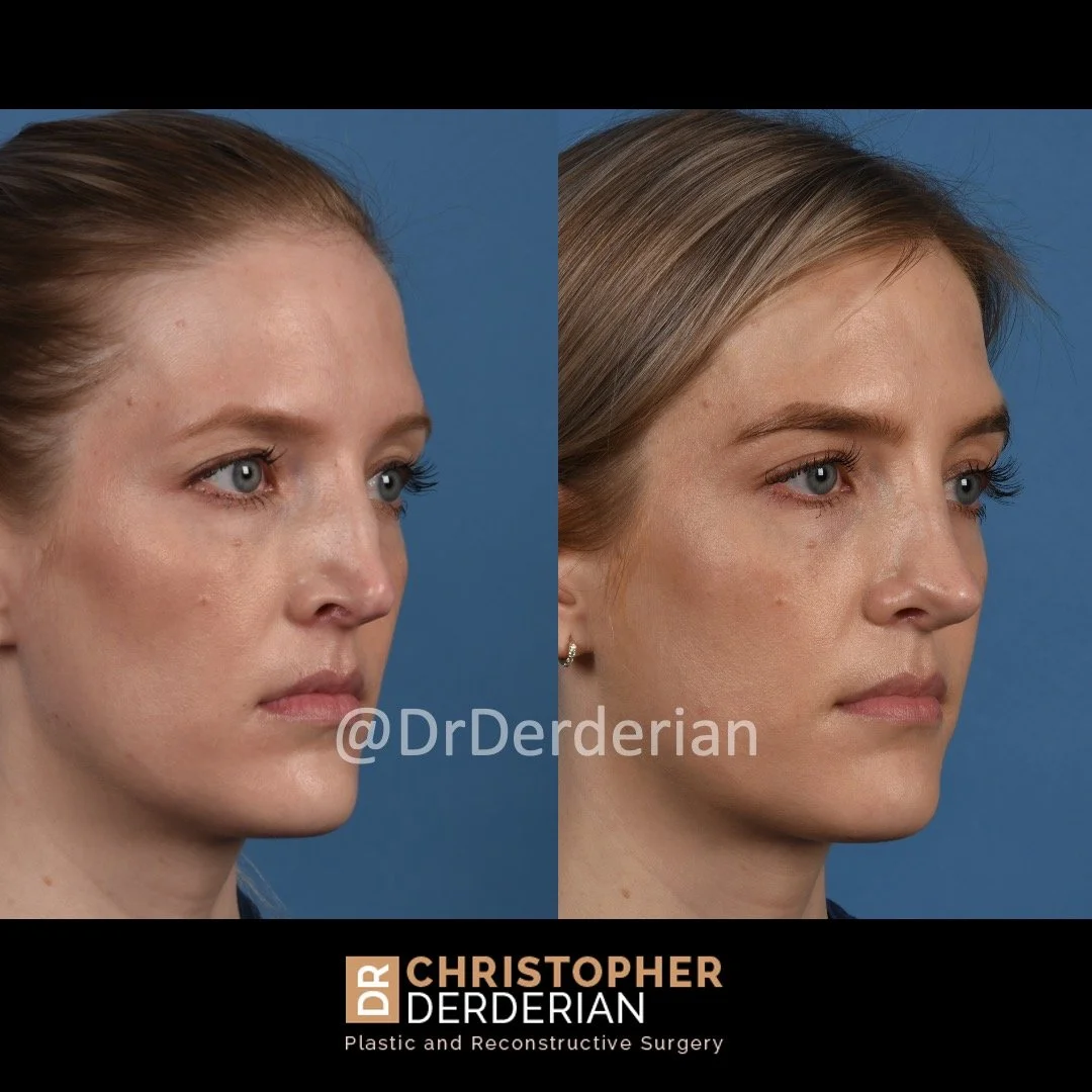 drderderian rhinoplasty before and after 2 right 3:4.jpeg