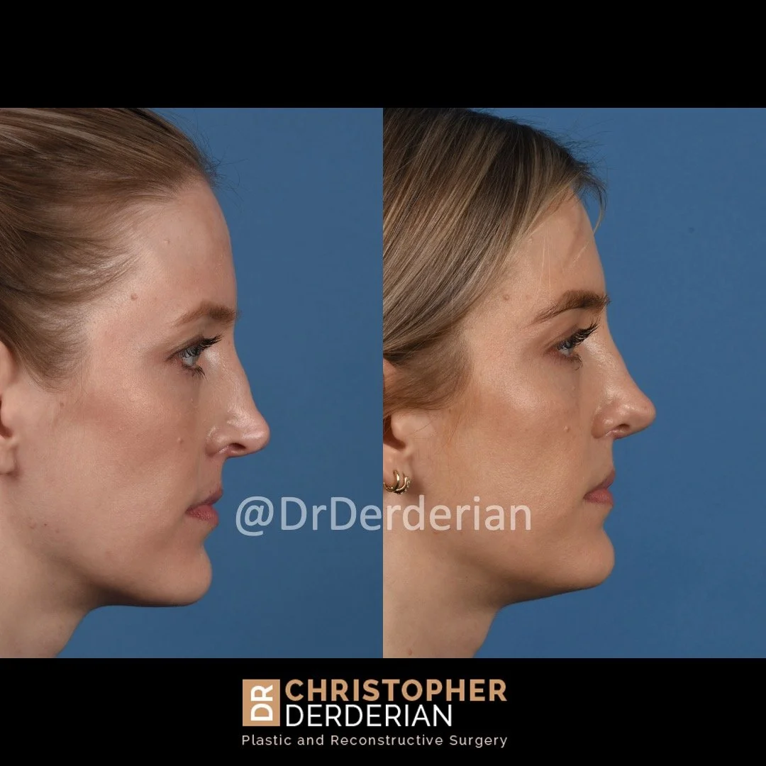 drderderian rhinoplasty before and after 2 right lateral.jpeg