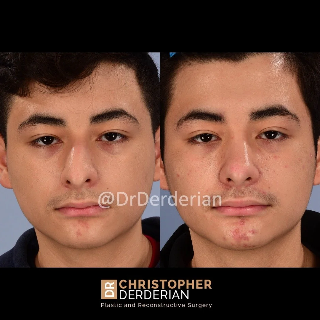 drderderian rhinoplasty before and after 3 AP.jpeg