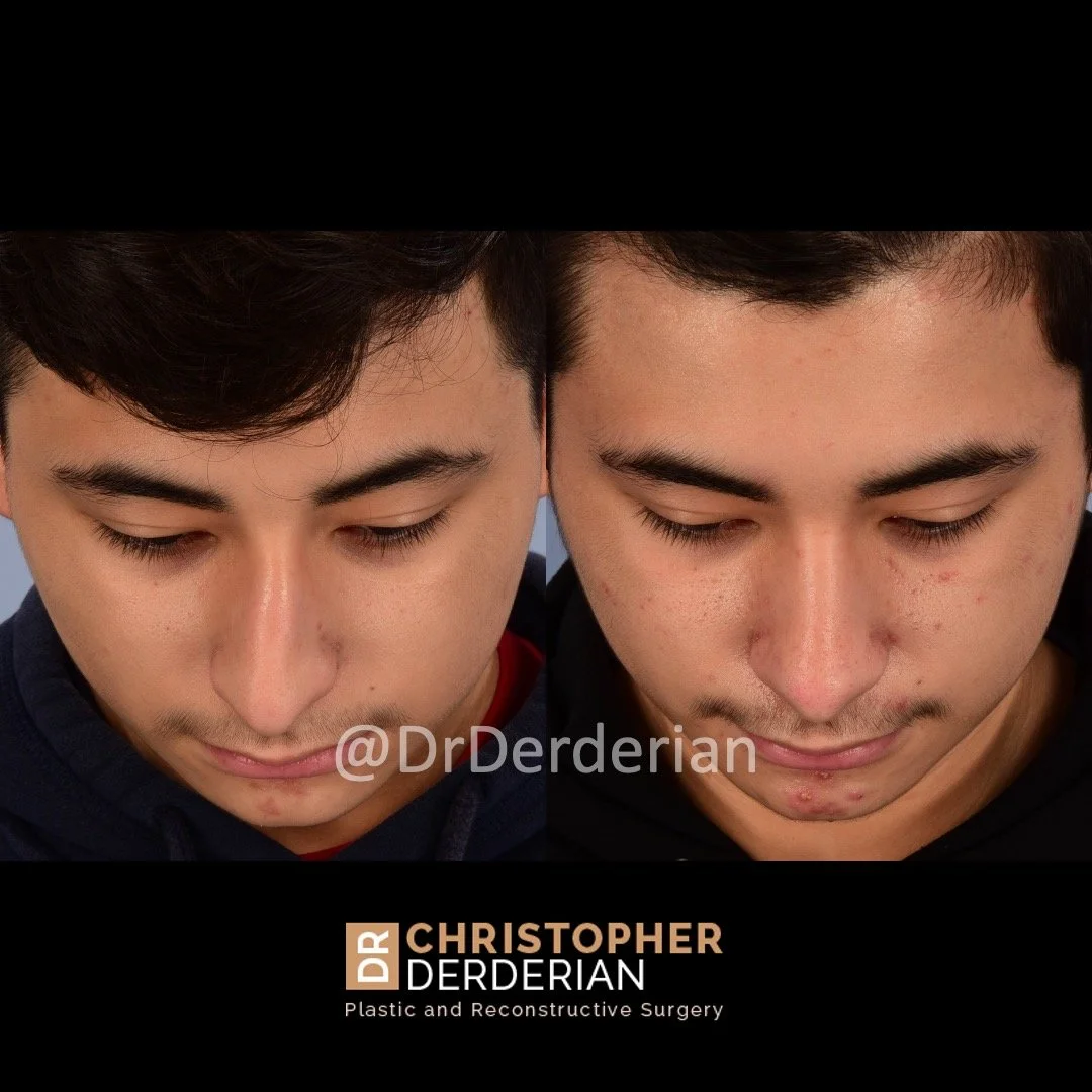 drderderian rhinoplasty before and after 3 above.jpeg