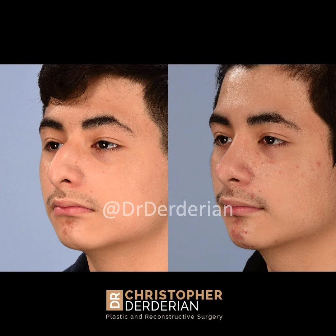drderderian rhinoplasty before and after 3 left 3:4.jpeg