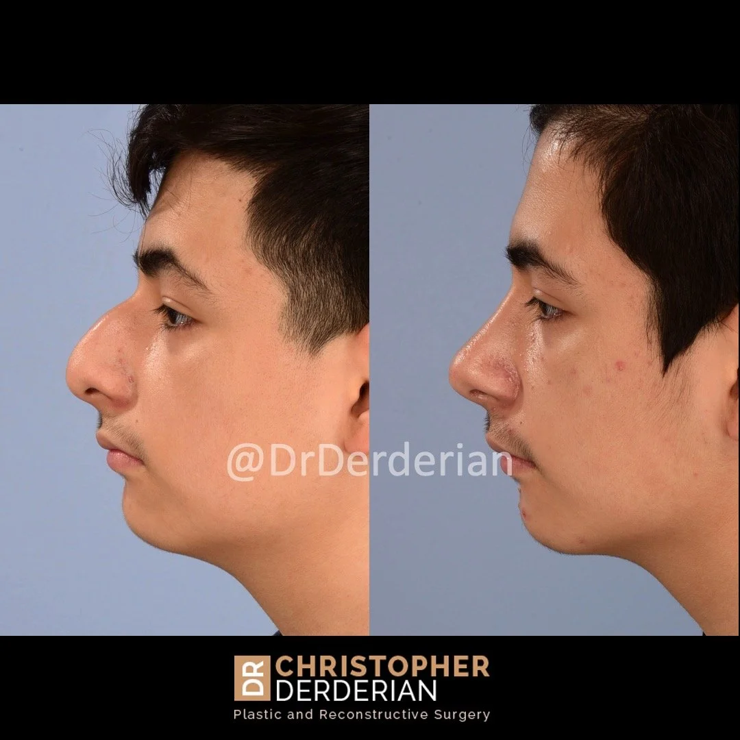 drderderian rhinoplasty before and after 3 left lateral.jpeg