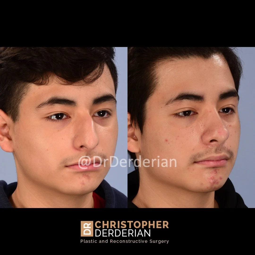 drderderian rhinoplasty before and after 3 right 3:4.jpeg