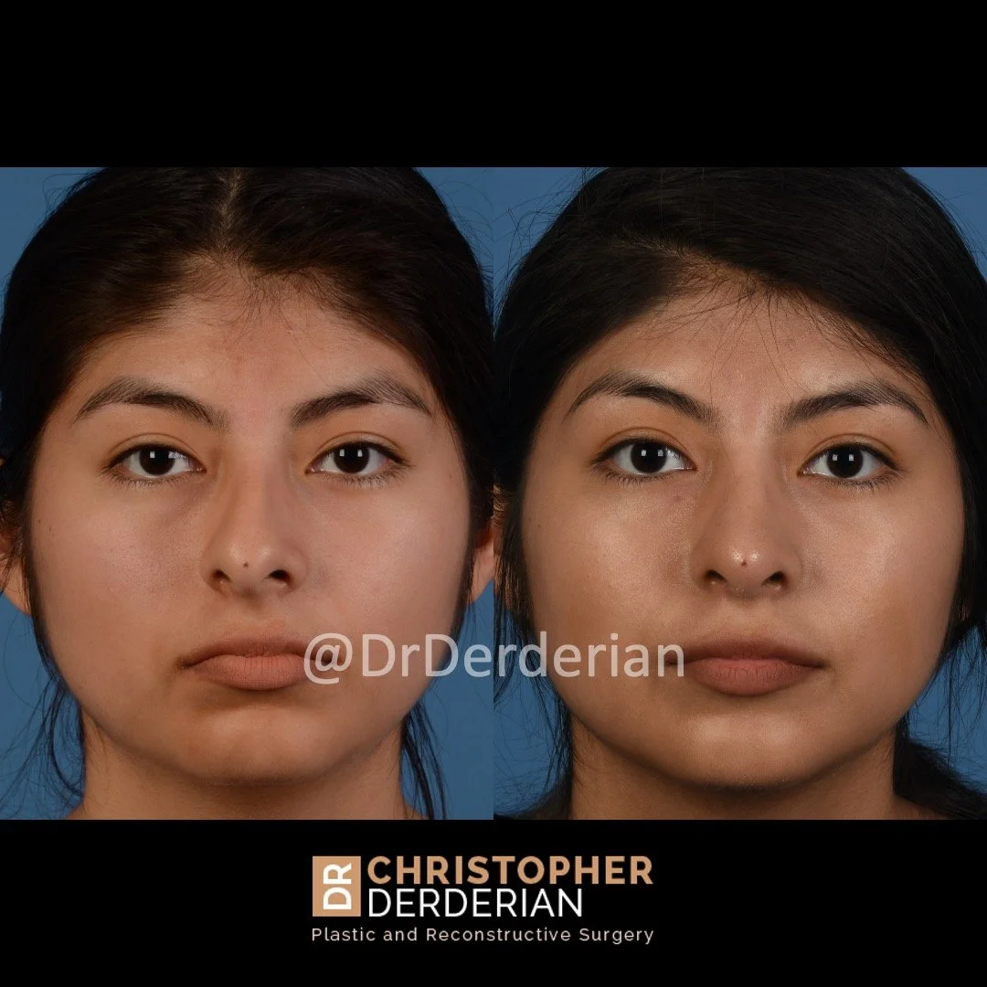 drderderian rhinoplasty before and after 5 AP.jpeg