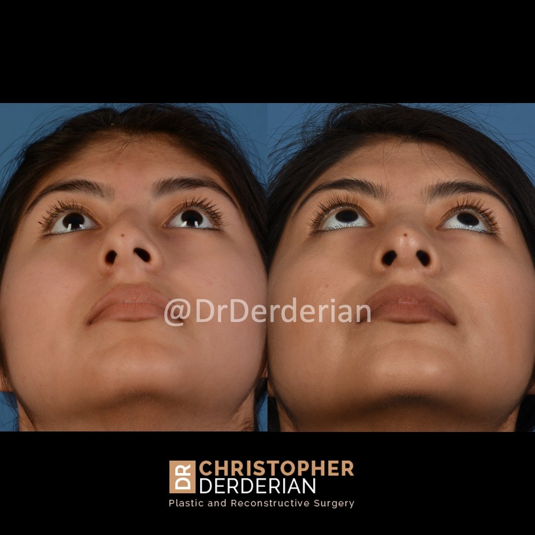 drderderian rhinoplasty before and after 5 below.jpeg
