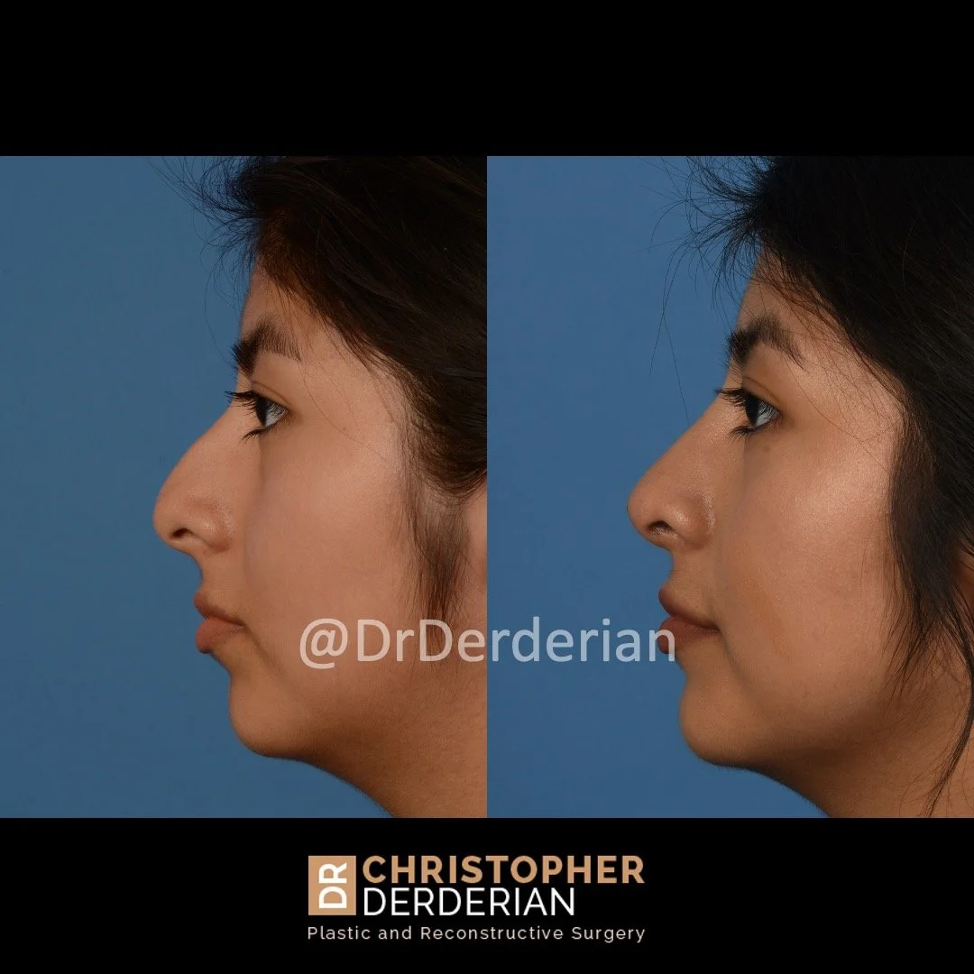 drderderian rhinoplasty before and after 5 left lateral.jpeg