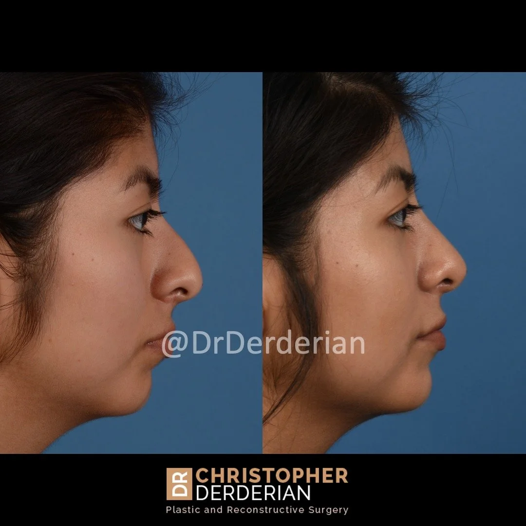 drderderian rhinoplasty before and after 5 Right lateral.jpeg