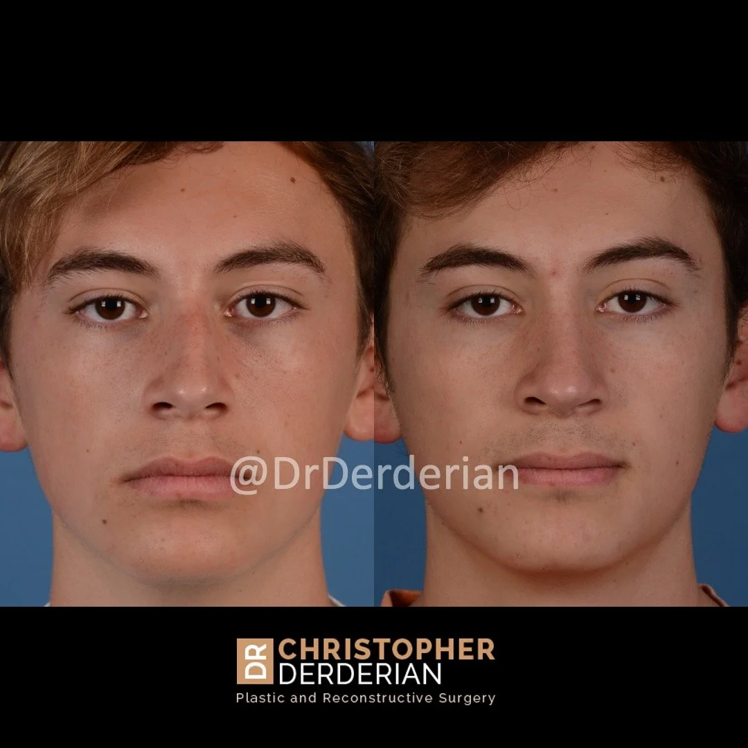 drderderian rhinoplasty before and after 6 AP.jpeg