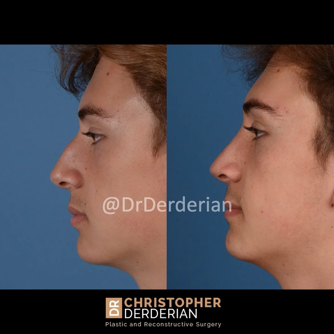 drderderian rhinoplasty before and after 6 left lateral.jpeg