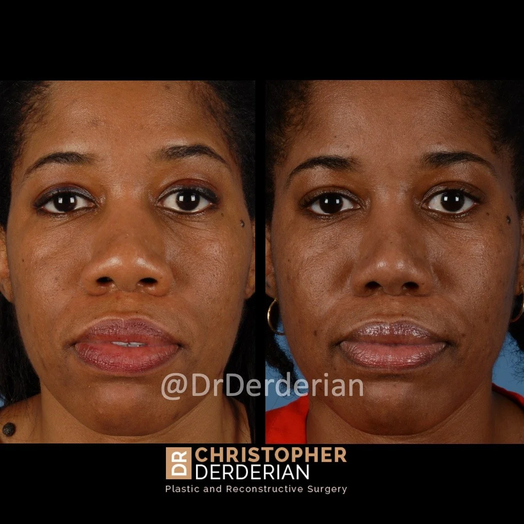 drderderian rhinoplasty before and after 4 AP.jpeg