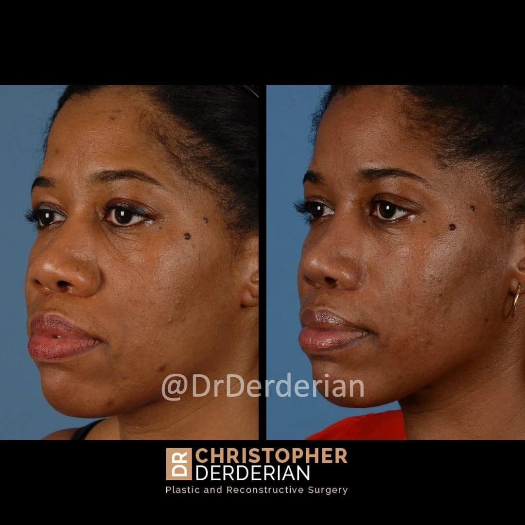 drderderian rhinoplasty before and after 4 left 3:4.jpeg