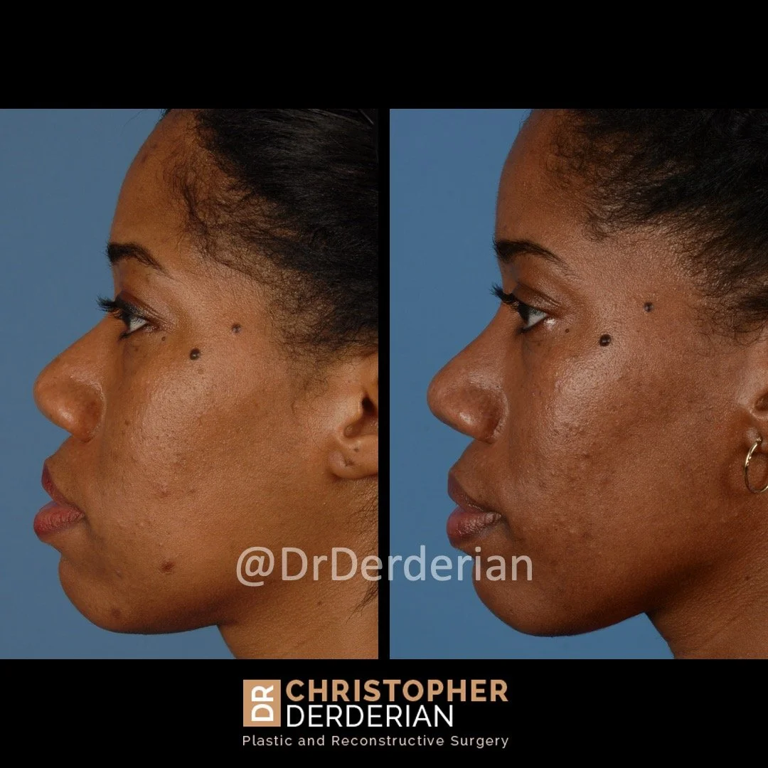 drderderian rhinoplasty before and after 4 left lateral.jpeg