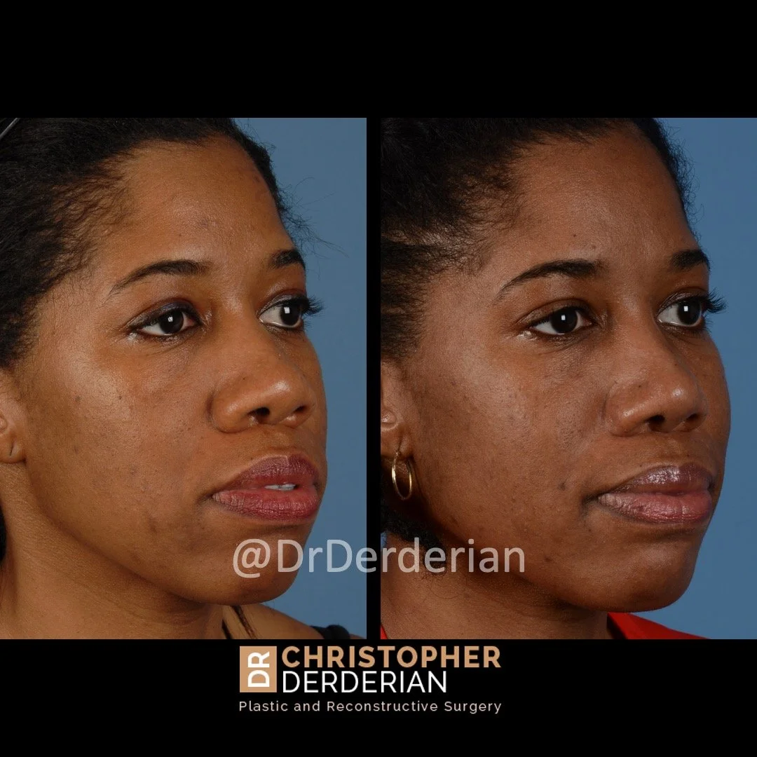 drderderian rhinoplasty before and after 4 right 3:4.jpeg