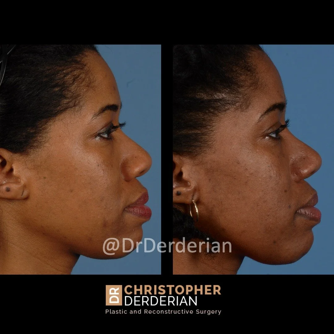 drderderian rhinoplasty before and after 4 right lateral.jpeg