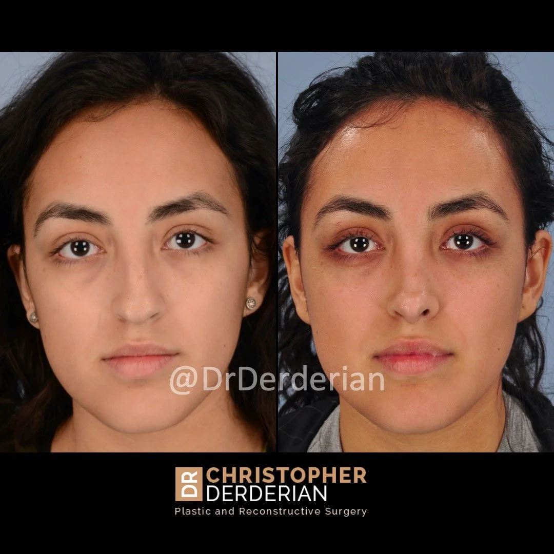 drderderian rhinoplasty before and after 1 AP.jpeg
