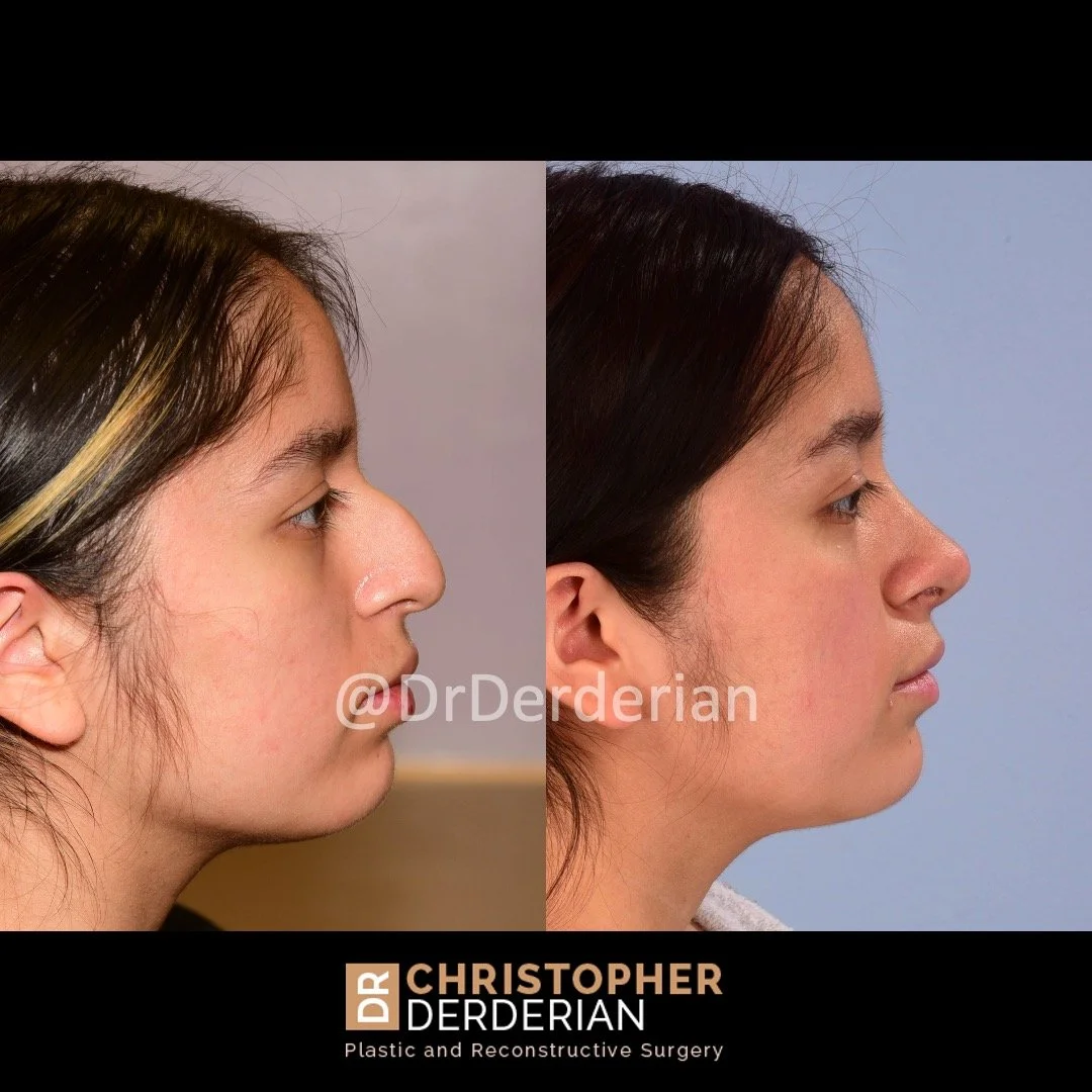 drderderian rhinoplasty before and after 8 right lateral.jpeg
