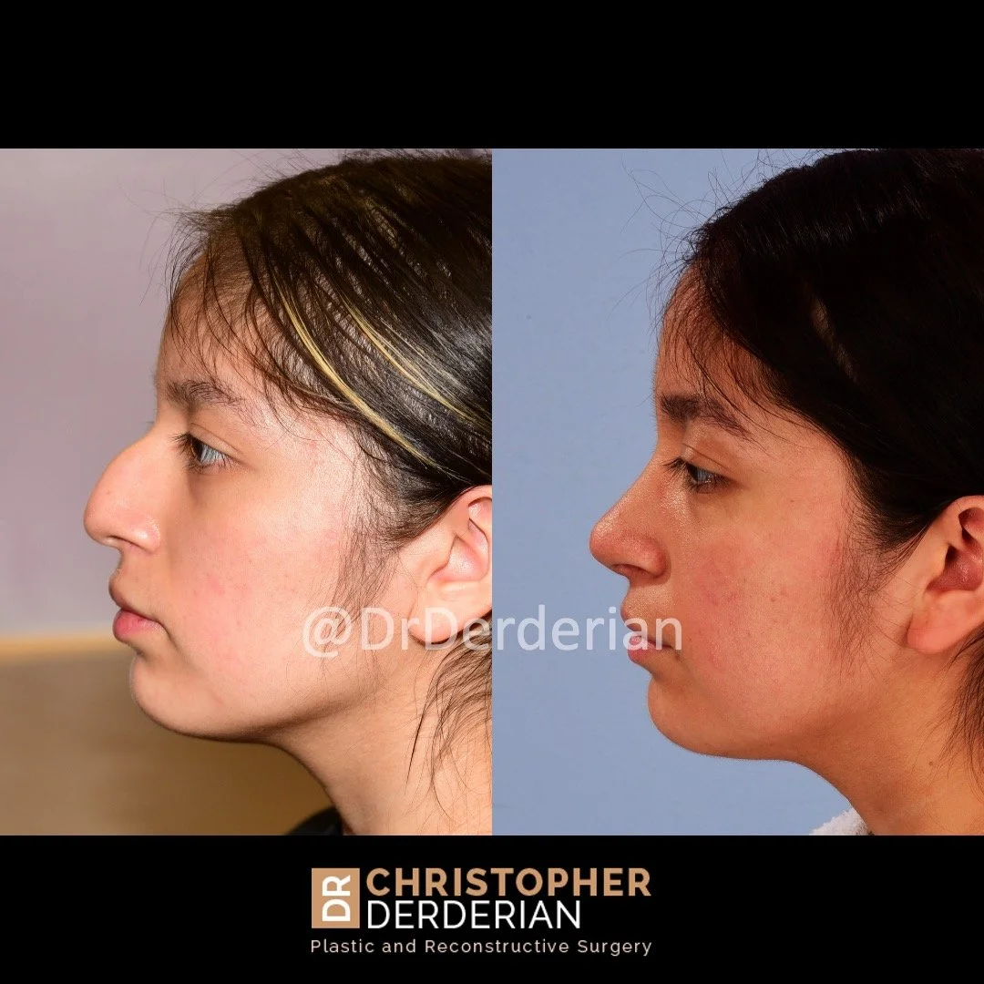 drderderian rhinoplasty before and after 8 left lateral.jpeg
