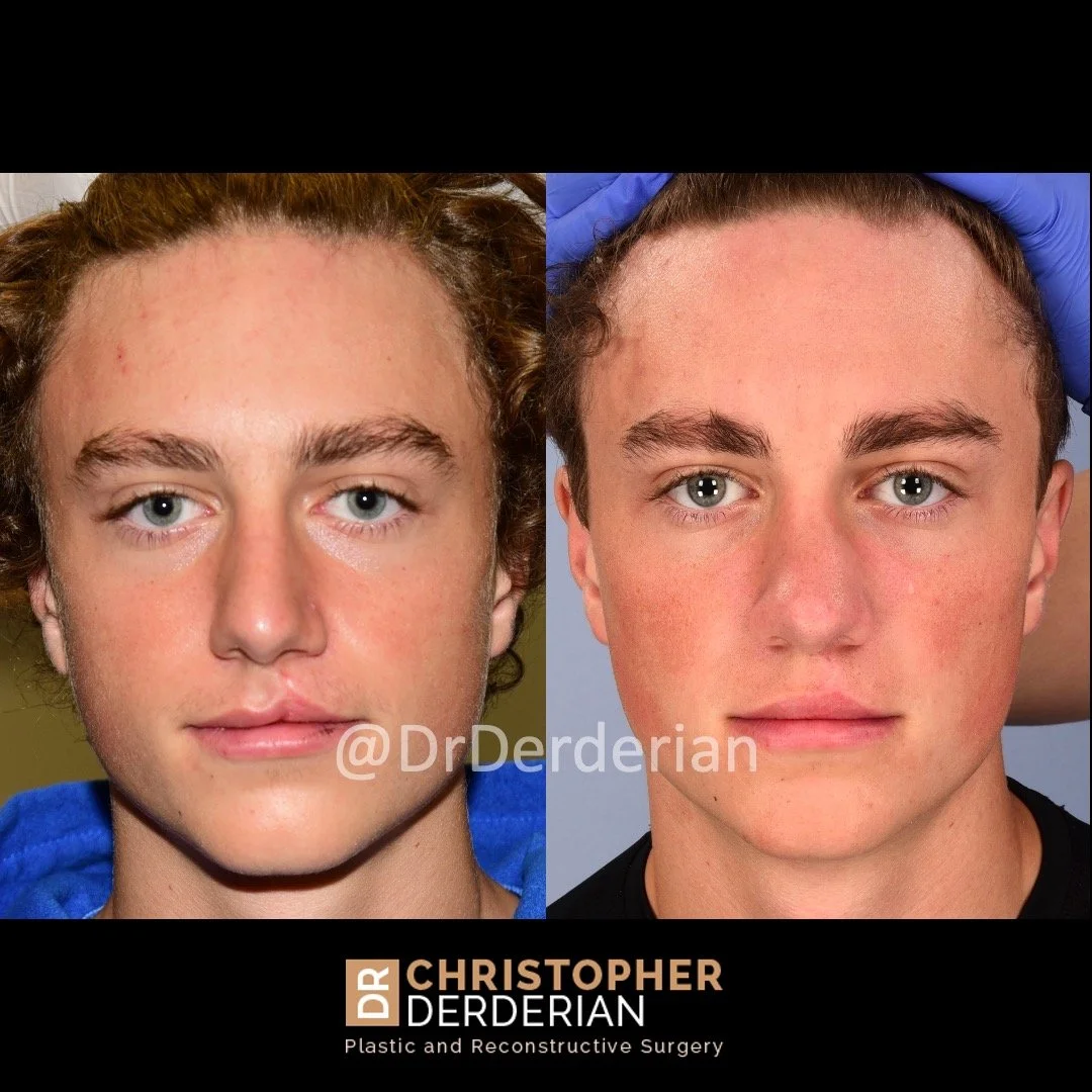 before and after cleft rhinoplasty and cleft lip revision case 1 AP
