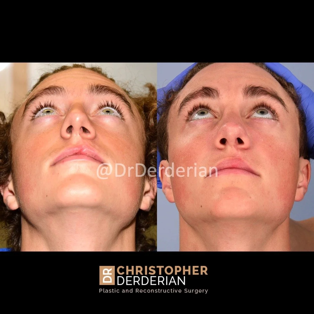 before and after cleft rhinoplasty and cleft lip revision case 1 below view