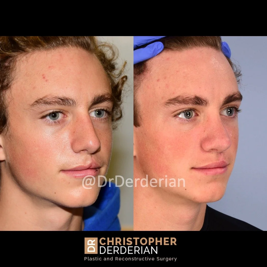 before and after cleft rhinoplasty and cleft lip revision case 1 right 3/4