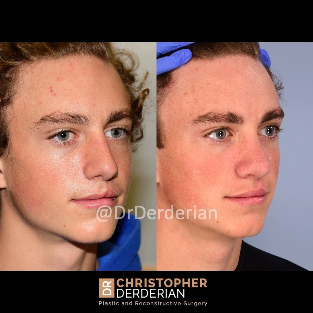 Cleft Rhinoplasty — Dr Derderian — Plastic and Reconstructive Surgery