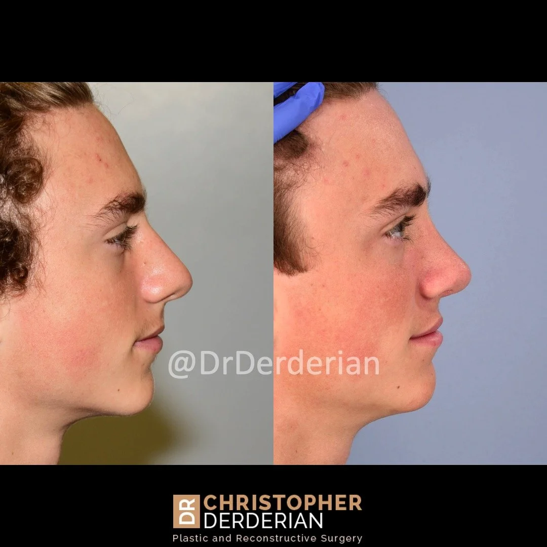 before and after cleft rhinoplasty and cleft lip revision case 1 right lateral