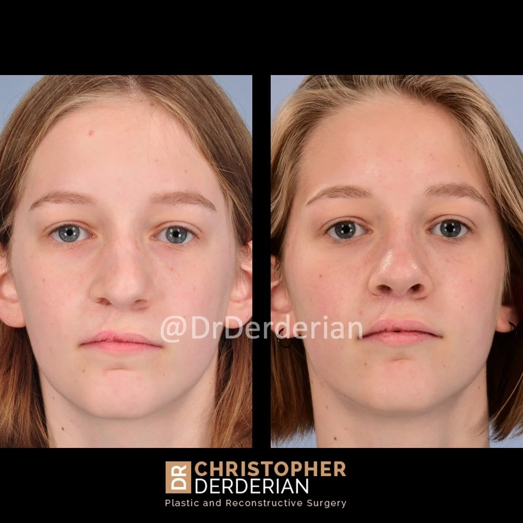 before and after cleft rhinoplasty case 2 AP
