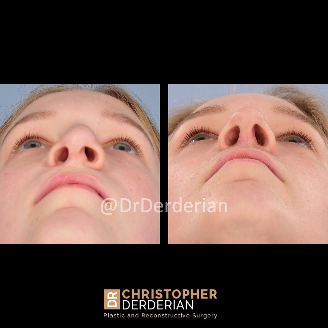 before and after cleft rhinoplasty case 2 below view