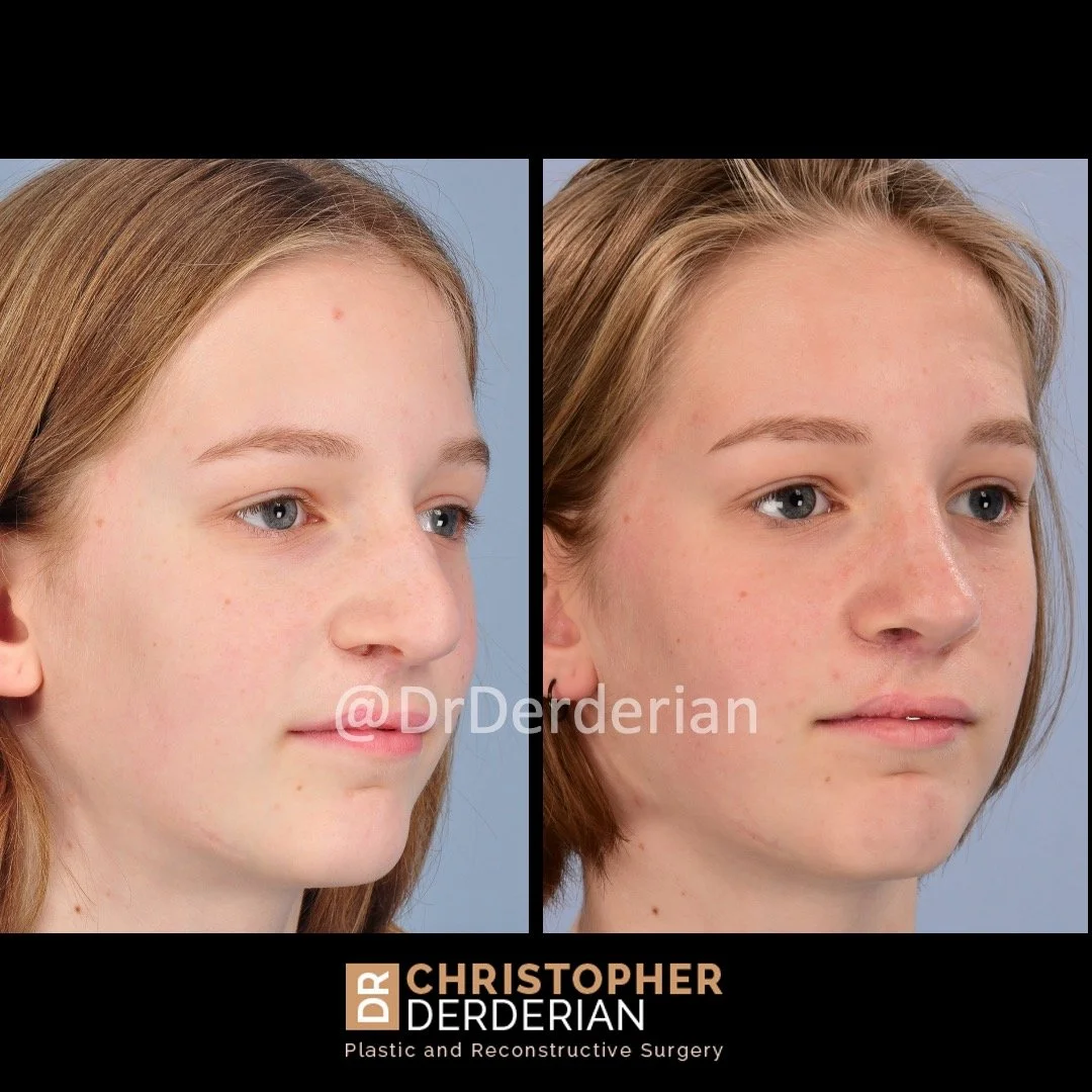 before and after cleft rhinoplasty case 2 right 3/4