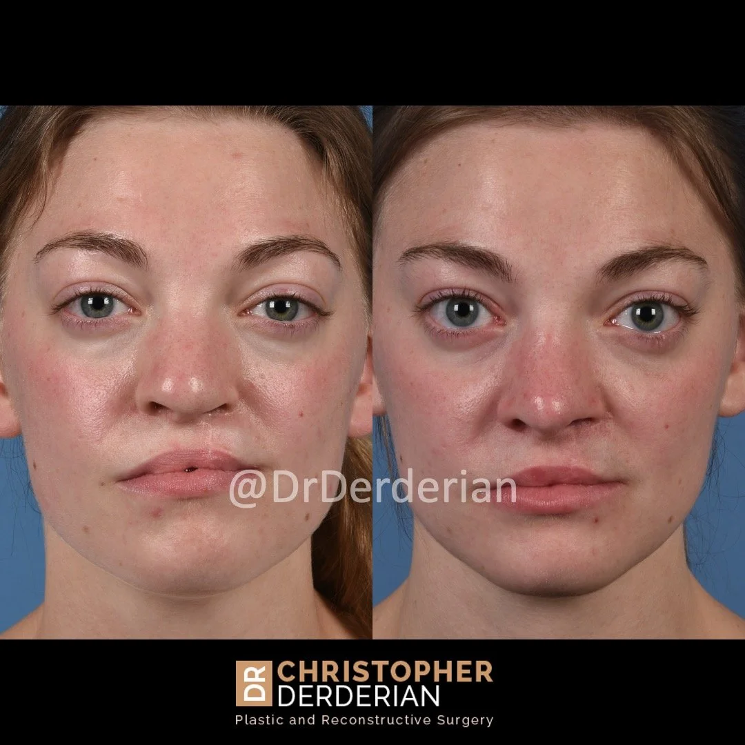 before and after cleft rhinoplasty and cleft lip fat grafting case 4 AP