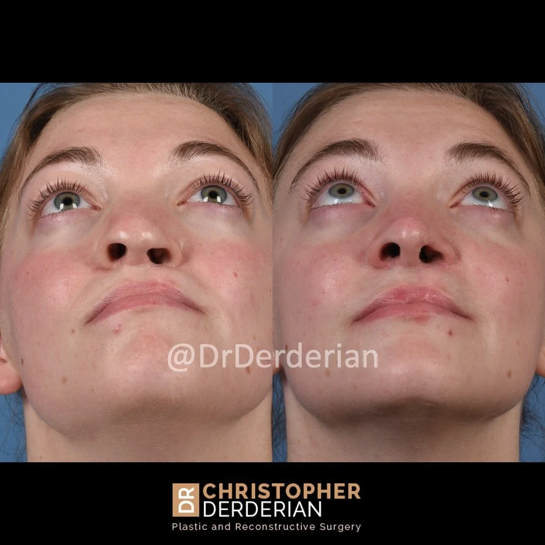 Cleft Rhinoplasty — Dr Derderian — Plastic and Reconstructive Surgery