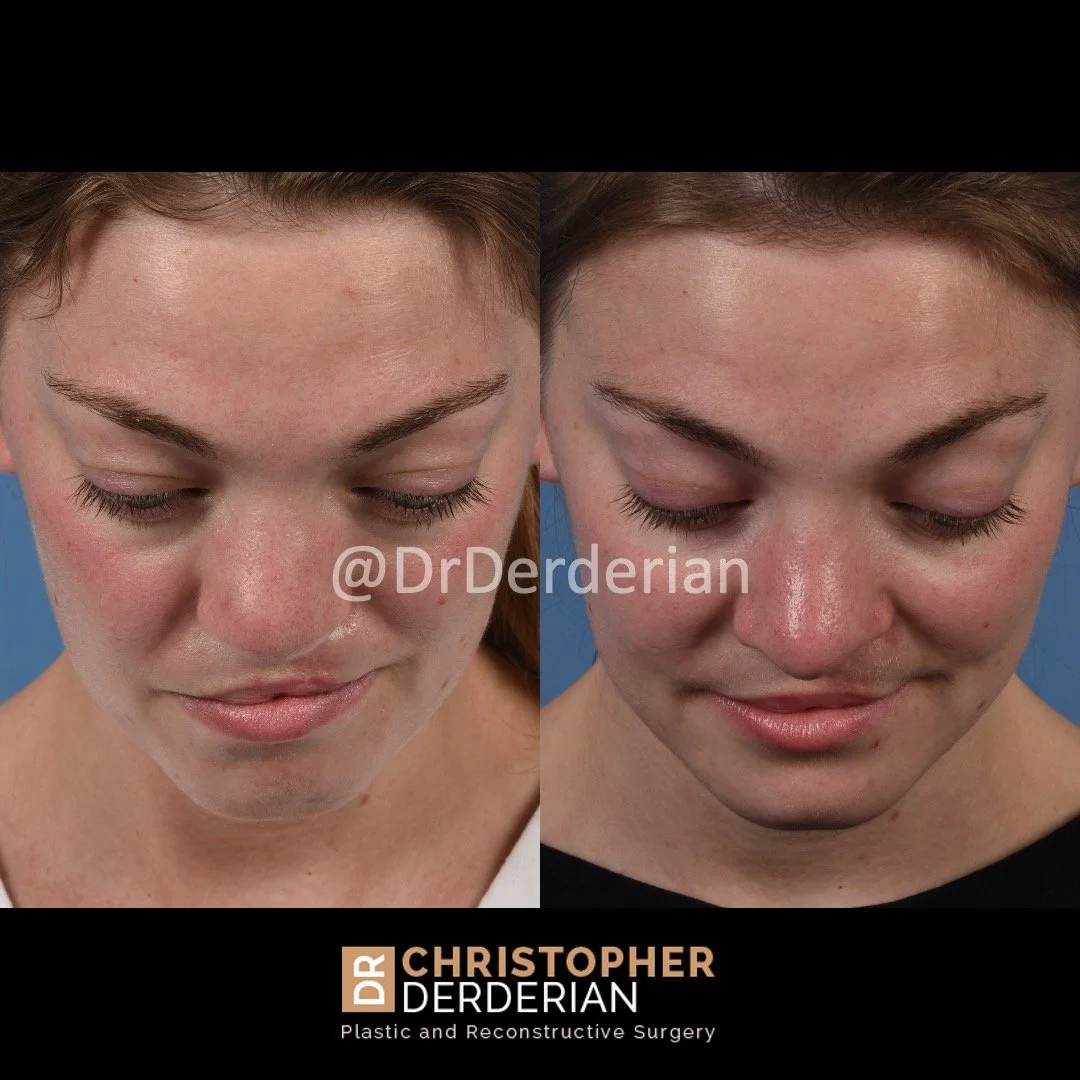 before and after cleft rhinoplasty and cleft lip revision case 4 above view