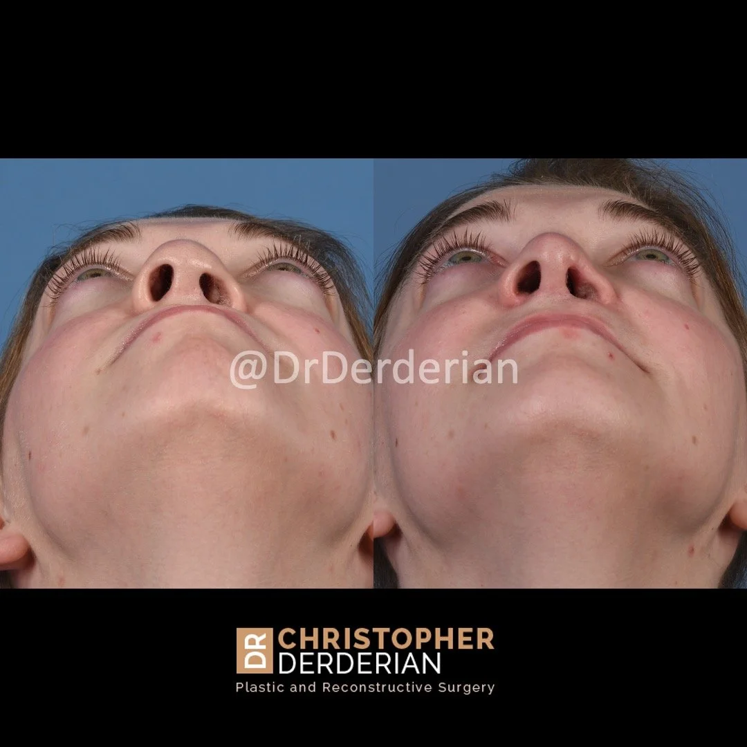 before and after cleft rhinoplasty and cleft lip revision case 4 below