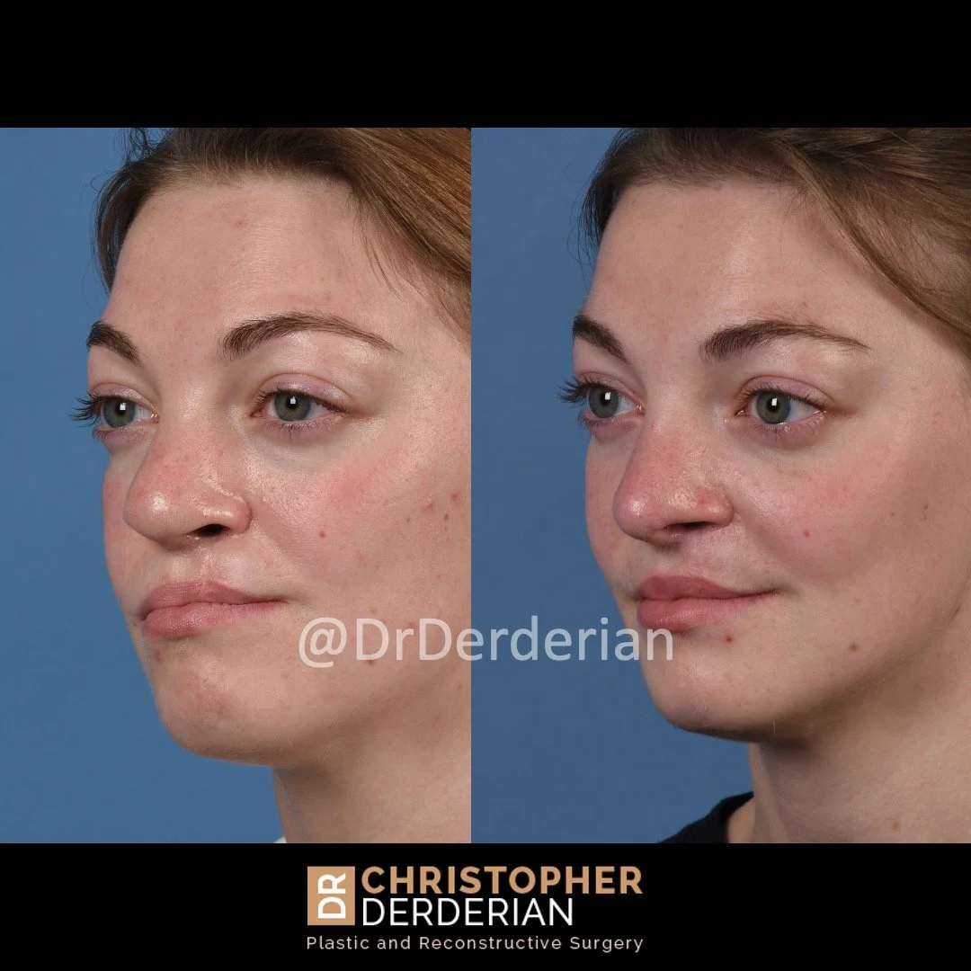 before and after cleft rhinoplasty and cleft lip revision case 4 Left 1/2