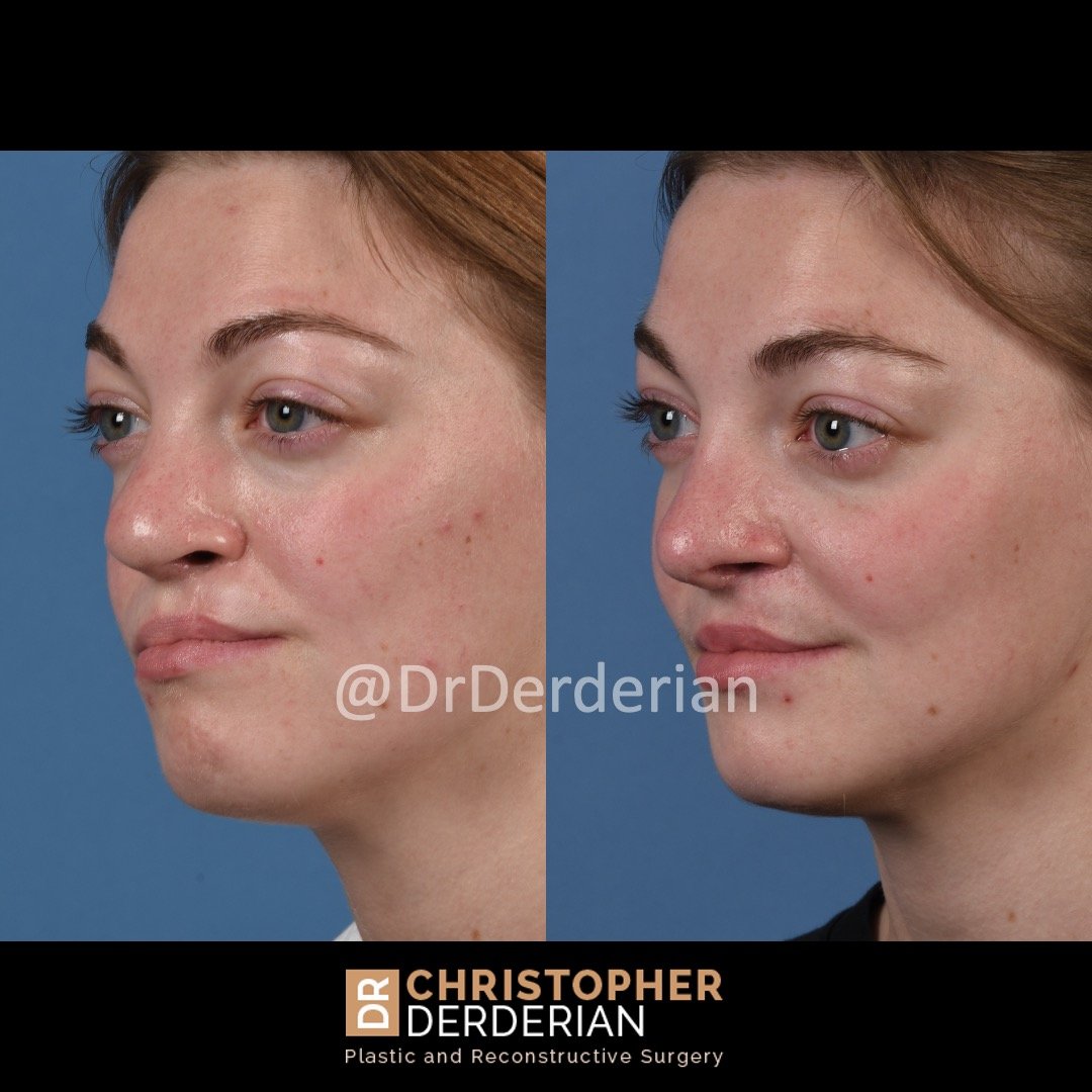before and after cleft rhinoplasty and cleft lip revision case 4 left 3/4