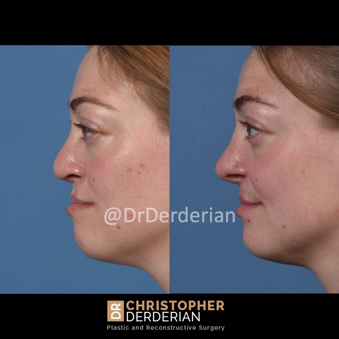 before and after cleft rhinoplasty and cleft lip revision case 4 left lateral