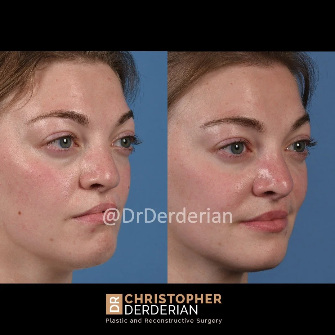 before and after cleft rhinoplasty and cleft lip revision case 4 right 1/2
