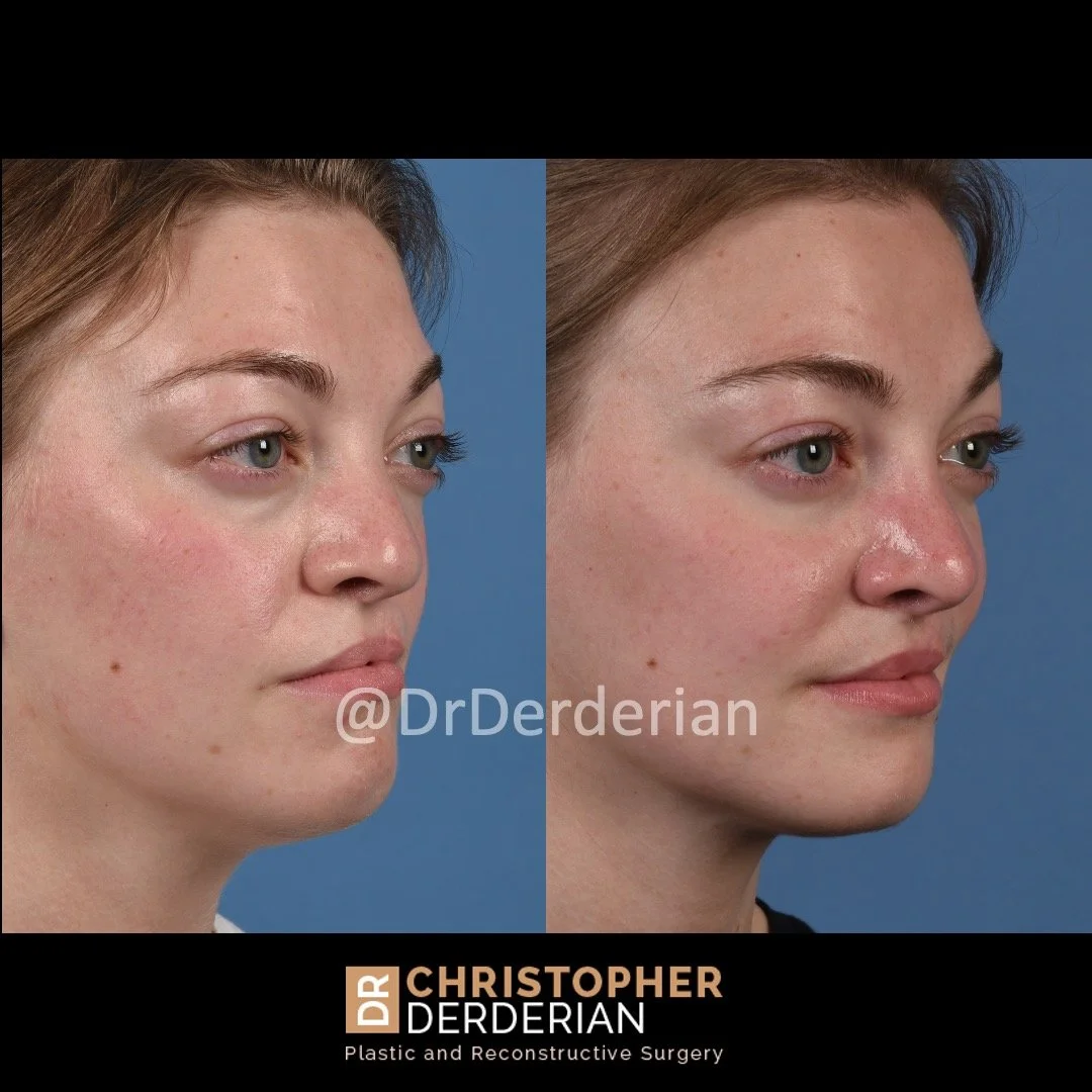 before and after cleft rhinoplasty and cleft lip revision case 4 right 3/4