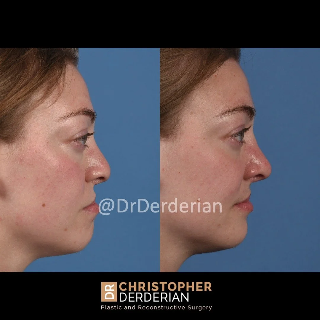 before and after cleft rhinoplasty and cleft lip revision case 4 right lateral